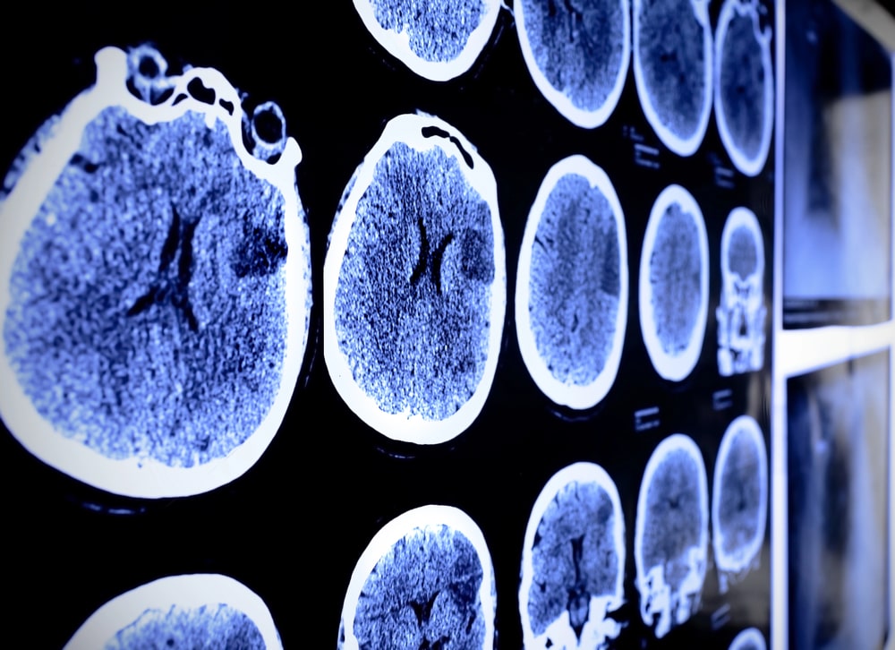traumatic brain injury lawyer Scottsdale AZ faqs